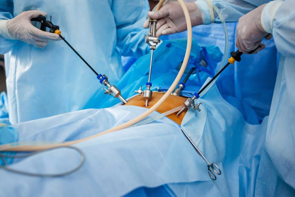 Laparoscopic GI Surgery